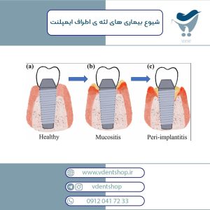 شیوع بیماری های لثه ی اطراف ایمپلنت