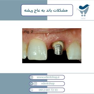 مشکلات باند به عاج ریشه