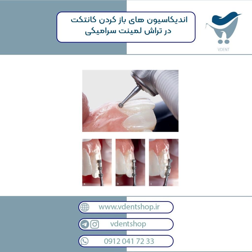 اندیکاسیون های باز کردن کانتکت در تراش لمینت سرامیکی