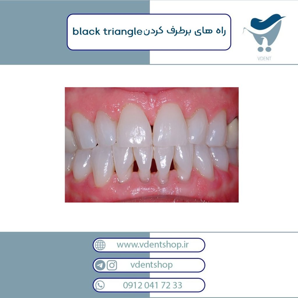 راه های برطرف کردن black triangle