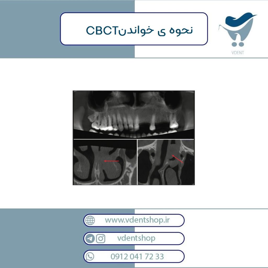 CBCT
