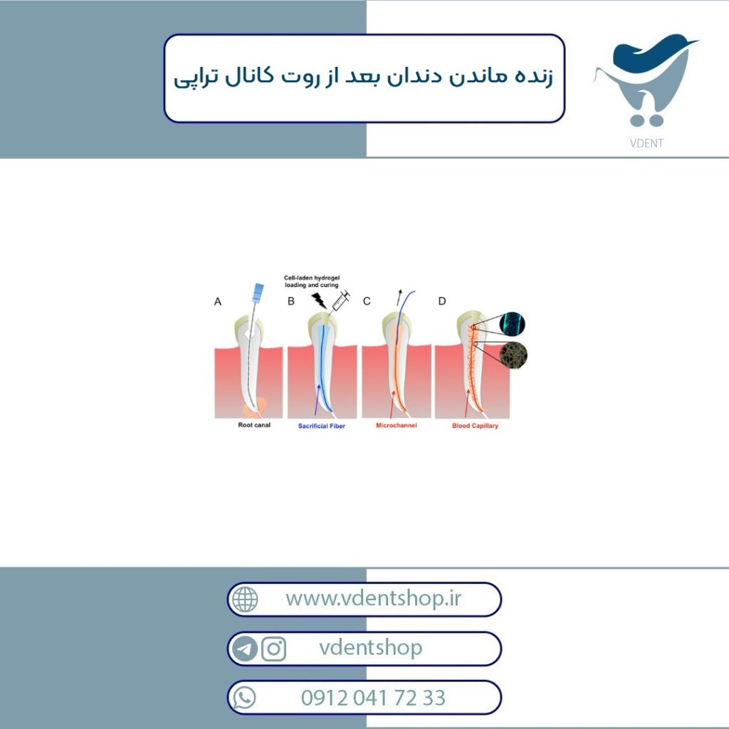 روت کانال