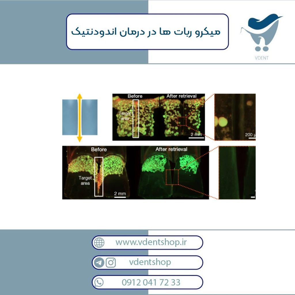 میکرو ربات ها در درمان اندودنتیک