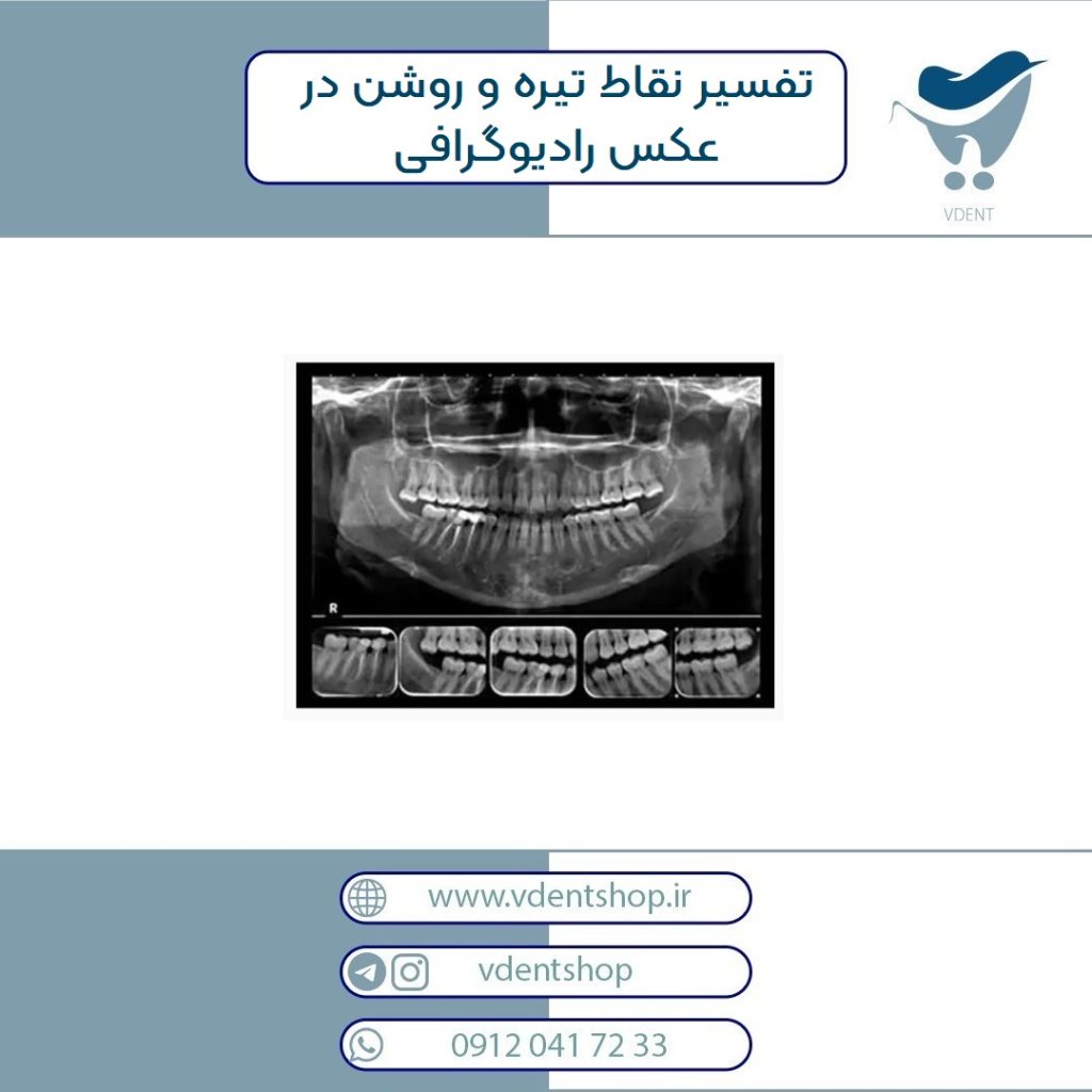 راهنمای نحوه تشخیص پوسیدگی دندان از روی عکس ها