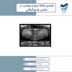 راهنمای نحوه تشخیص پوسیدگی دندان از روی عکس ها