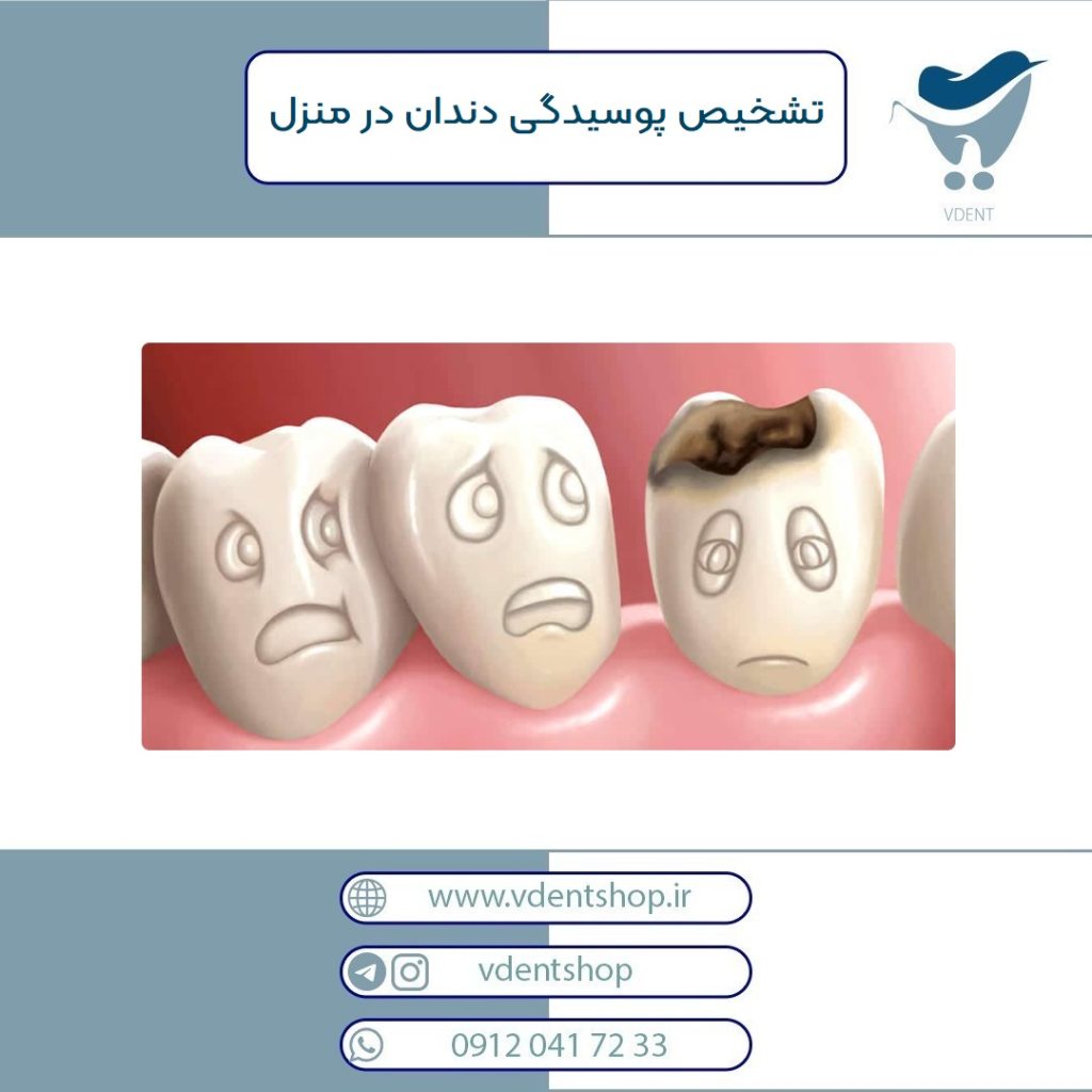 تشخیص پوسیدگی دندان در منزل