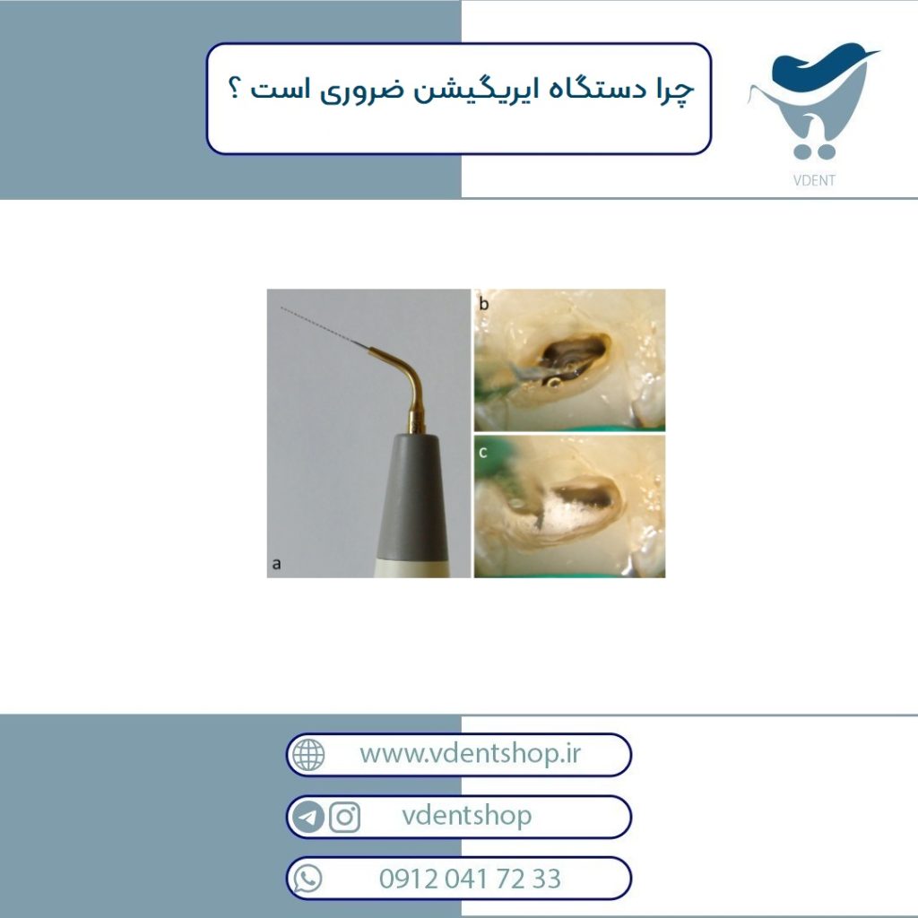اولتراسونیک ایریگیشن